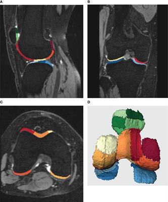 Quantitative MRI evaluation of articular cartilage in patients with meniscus tear